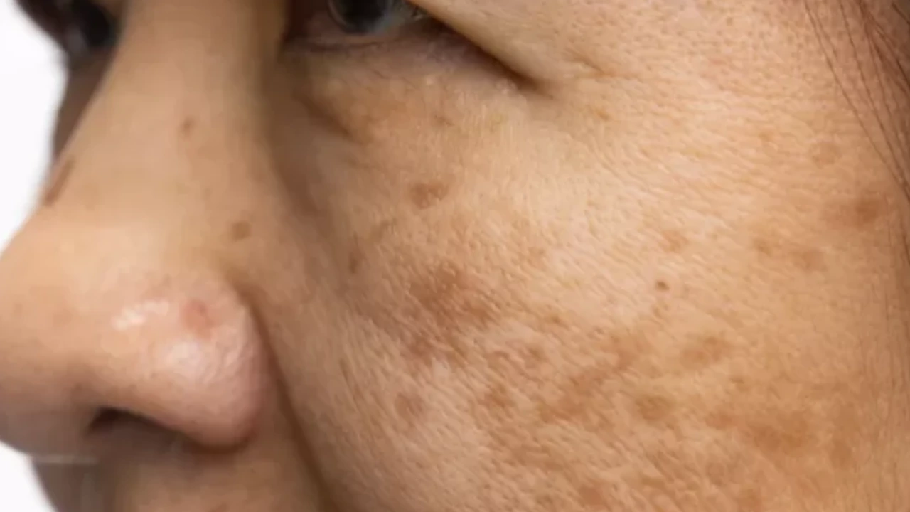 Actinic Keratosis