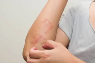Allergy